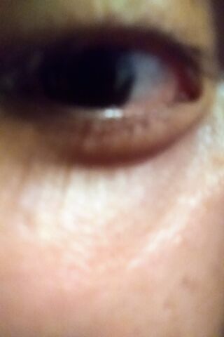 Eye