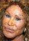 botox gone wrong